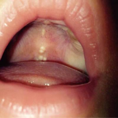 婴儿正常口腔上颚图片