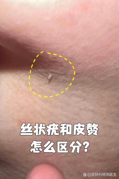 皮肤疣是什么样子图片