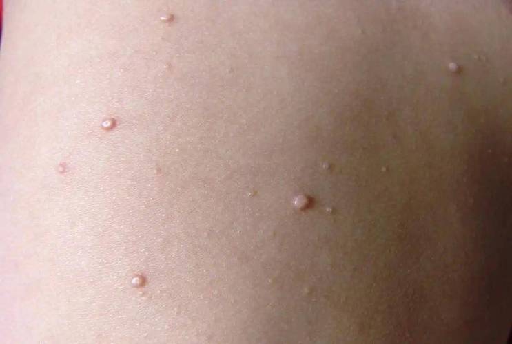 皮肤疣是什么样子图片