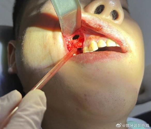 口腔开窗手术恢复期要多久?