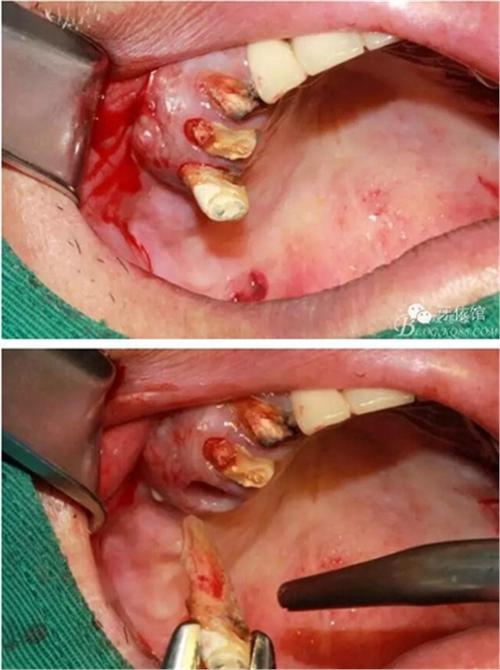 口腔开窗手术恢复期要多久?