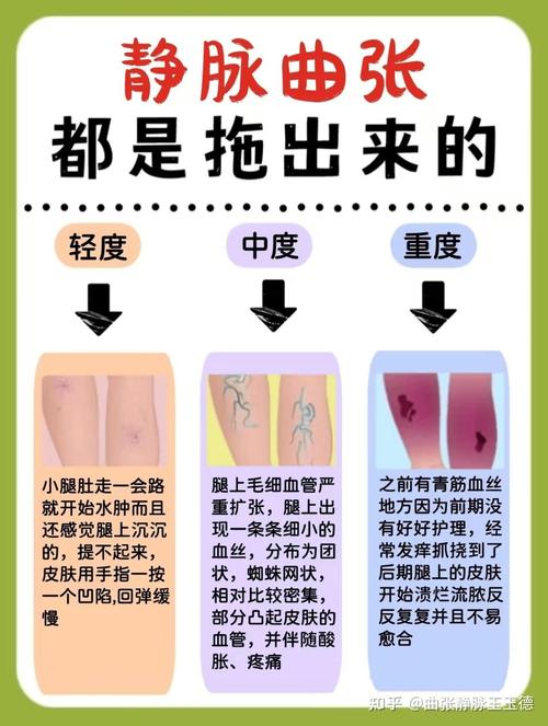 静脉曲张皮肤痒怎么快速缓解?