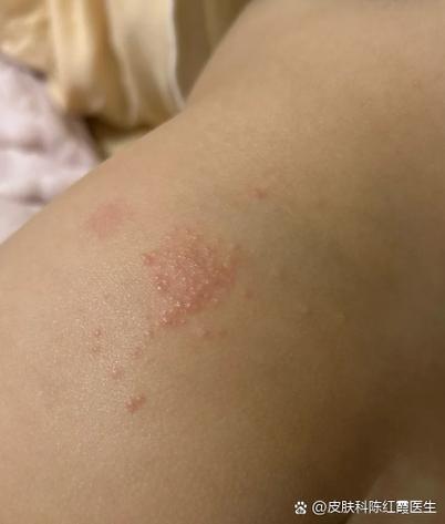 皮肤上起了很多小疙瘩