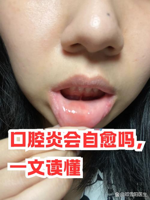 霉菌性口腔炎会传染吗