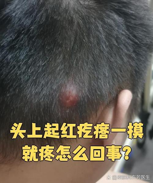 头顶皮肤疼是怎么回事