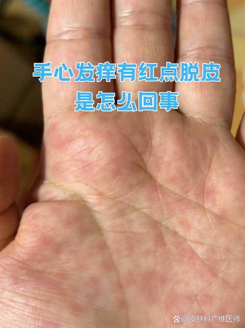 手掌皮肤痒是怎么回事