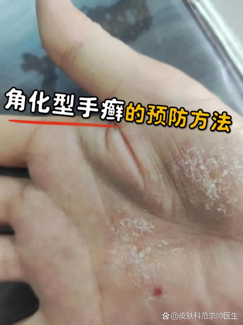 手掌皮肤痒是怎么回事