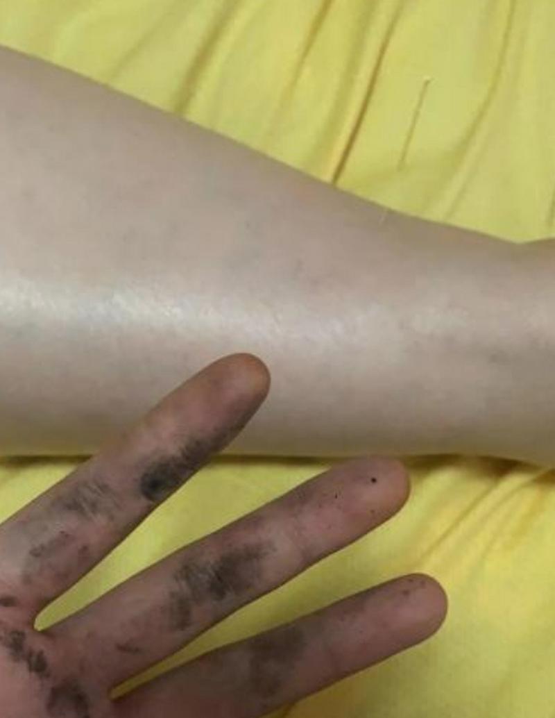 化疗后皮肤变黑怎么办