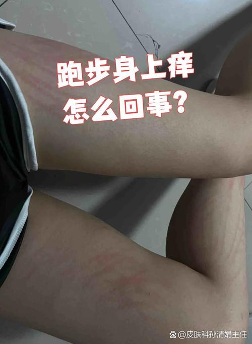 运动后皮肤发痒,是咋回事?