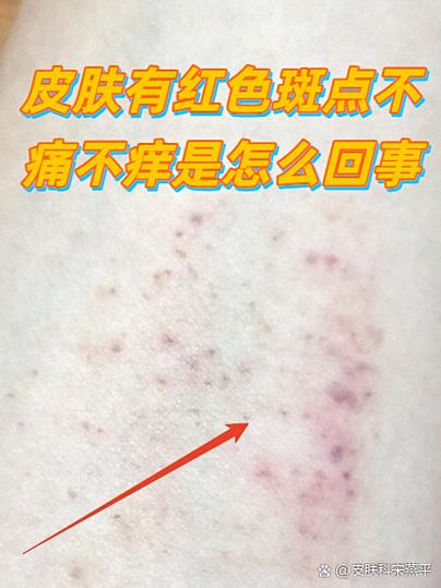 皮肤无故出血怎么回事