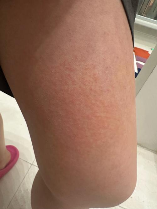 全身皮肤瘙痒起红疙瘩,是过敏还是什么问题?