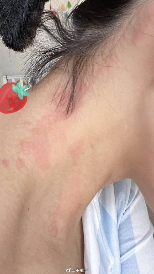 全身皮肤瘙痒起红疙瘩,是过敏还是什么问题?