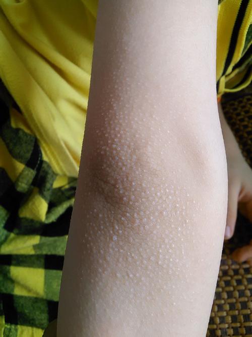 皮肤一粒粒像鸡皮疙瘩,是啥问题?