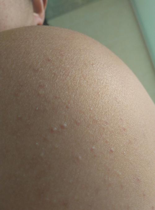 皮肤一粒粒像鸡皮疙瘩,是啥问题?