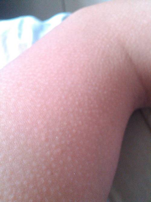 皮肤一粒粒像鸡皮疙瘩,是啥问题?