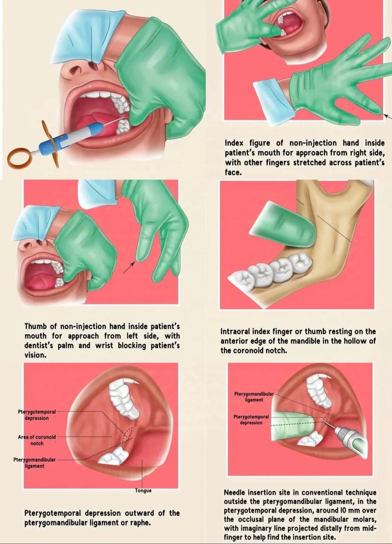 口腔打麻药后要注意什么?