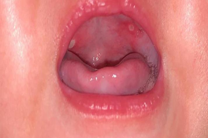 宝宝口腔红色点是什么?需要担心吗?