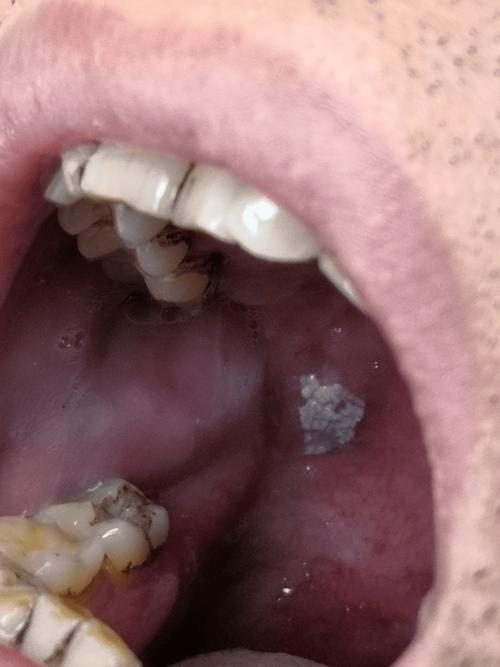 口腔粘膜白斑能自行消失吗?