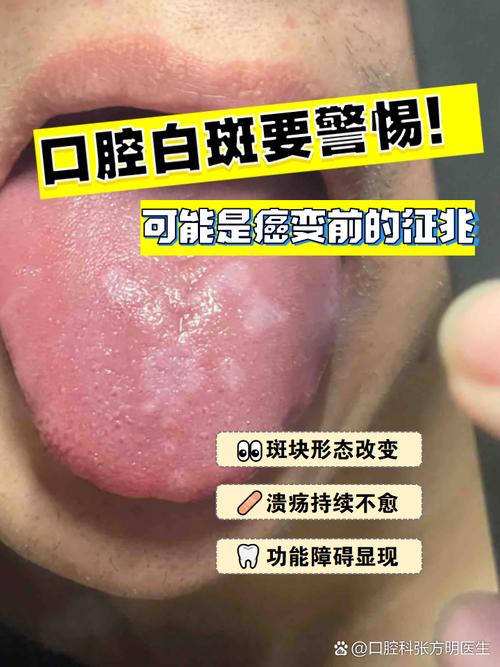 口腔粘膜白斑能自行消失吗?