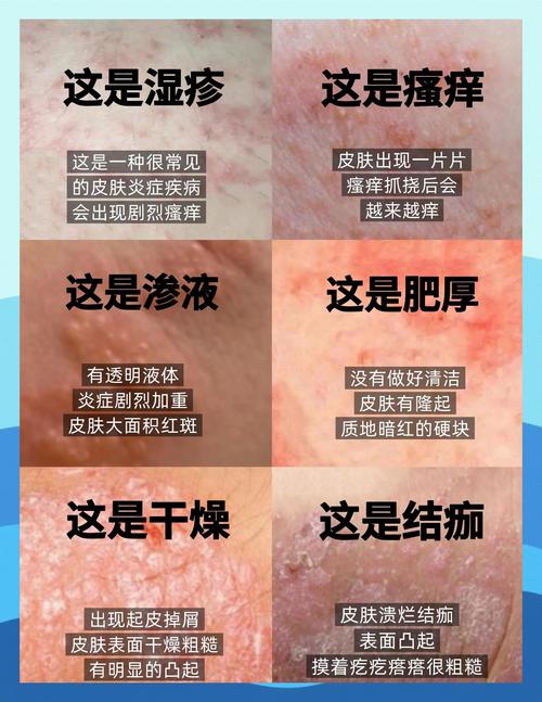 贴完膏药皮肤痒怎么办?