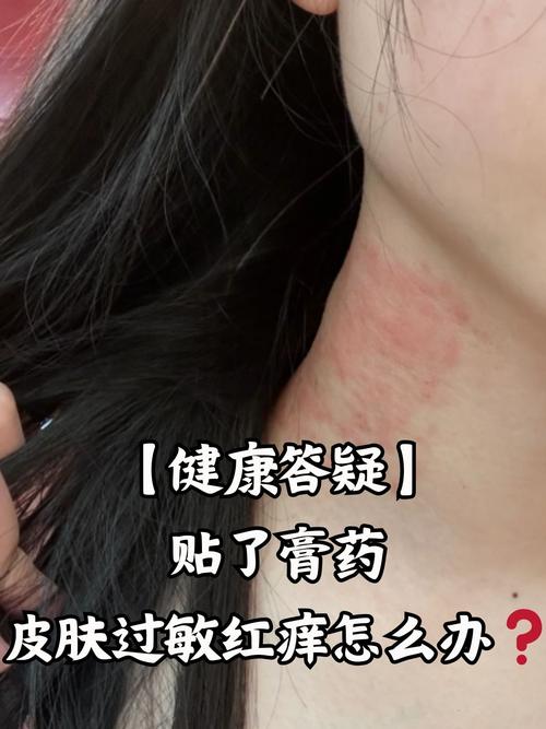 贴完膏药皮肤痒怎么办?