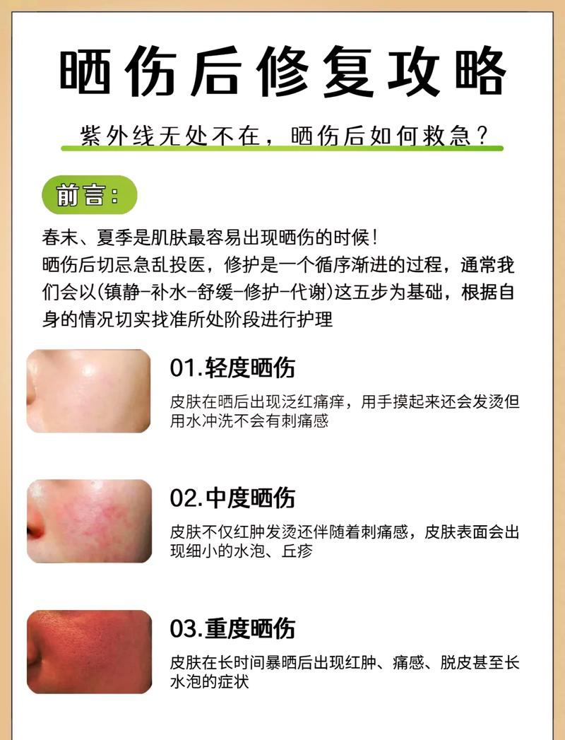 晒伤脱皮能撕吗?怎么护理才好?