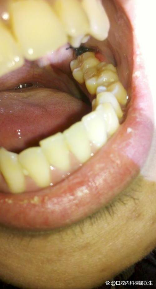 拔牙后洞里有食物残渣