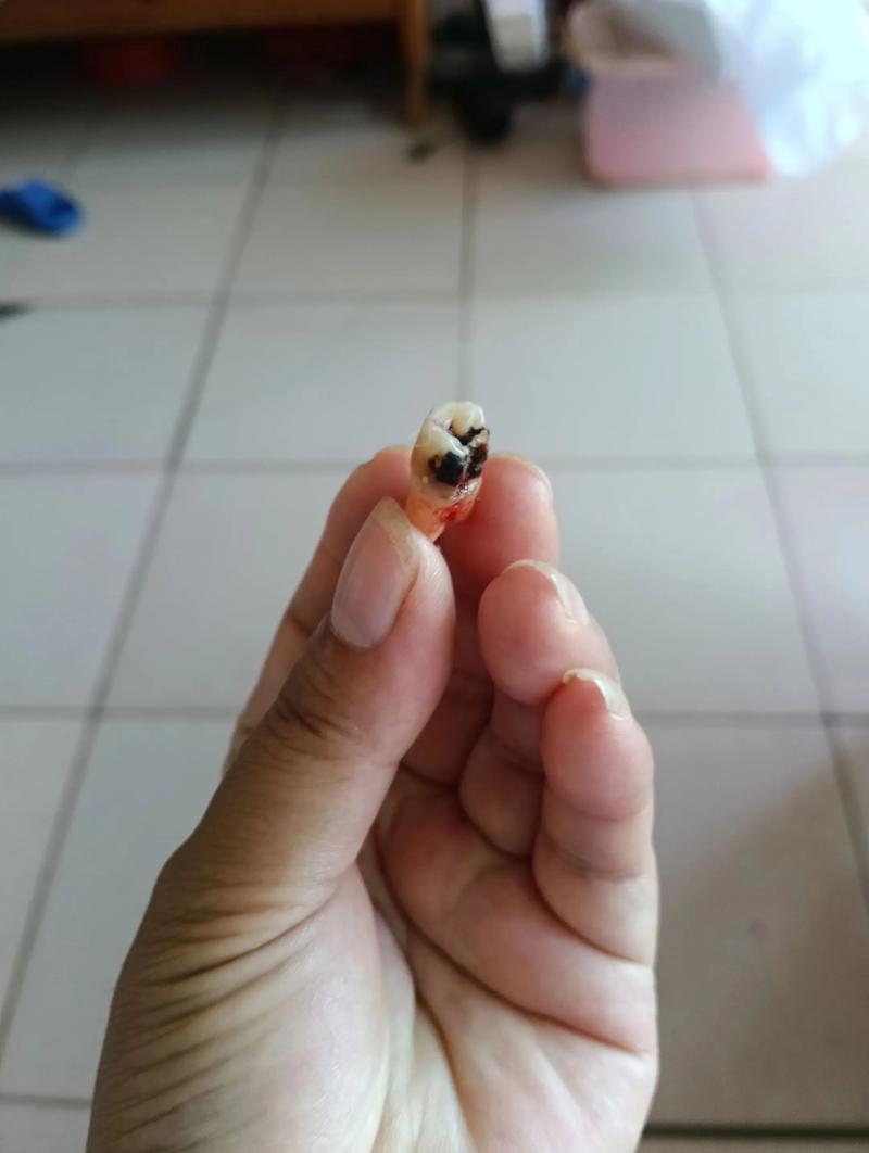 拔牙后洞里有食物残渣