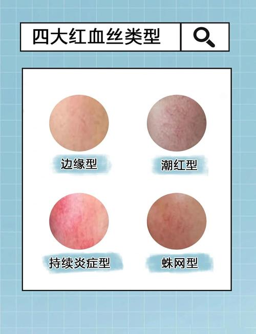 皮肤红血丝是怎么形成的?