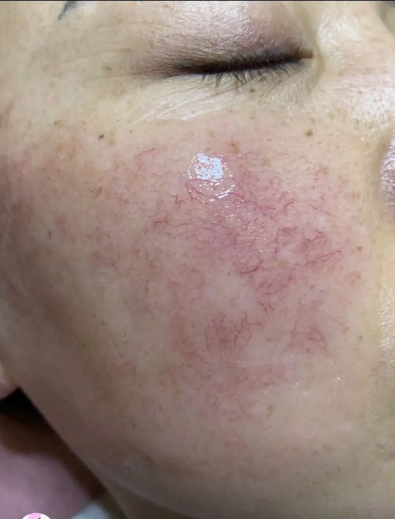 皮肤红血丝是怎么形成的?