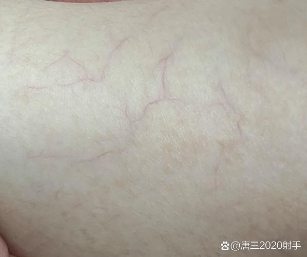 皮肤红血丝是怎么形成的?