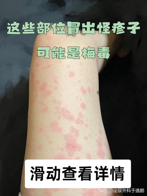 梅毒早期皮肤症状图片