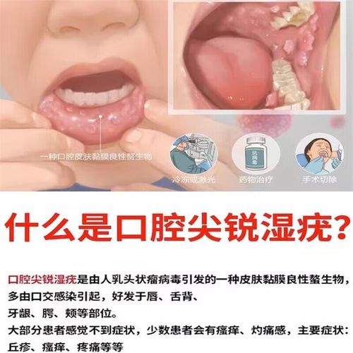 女性口腔尖锐湿疣用什么药好?
