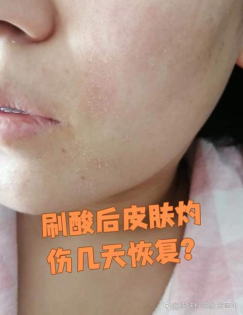 皮肤被辣椒辣了怎么办?