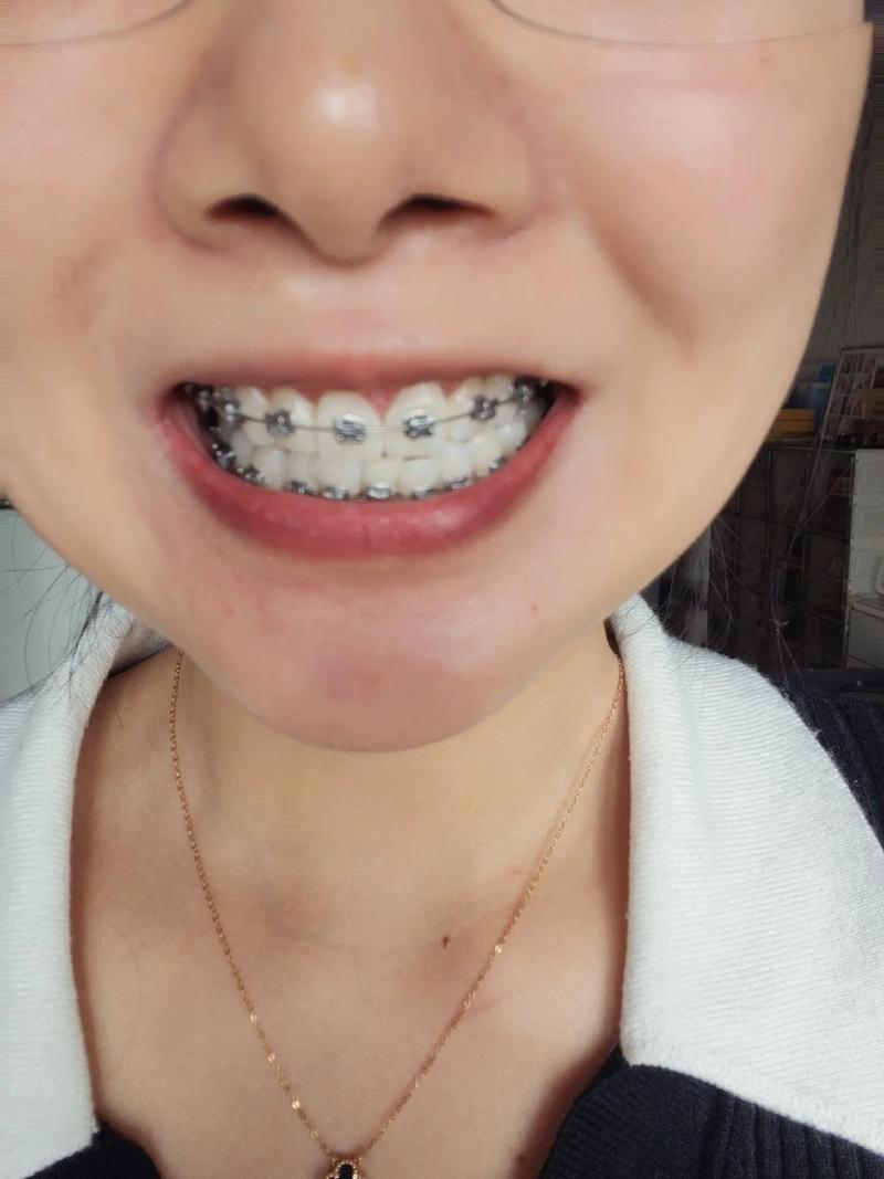 口腔正畸弓丝弯制视频,新手如何快速掌握技巧?