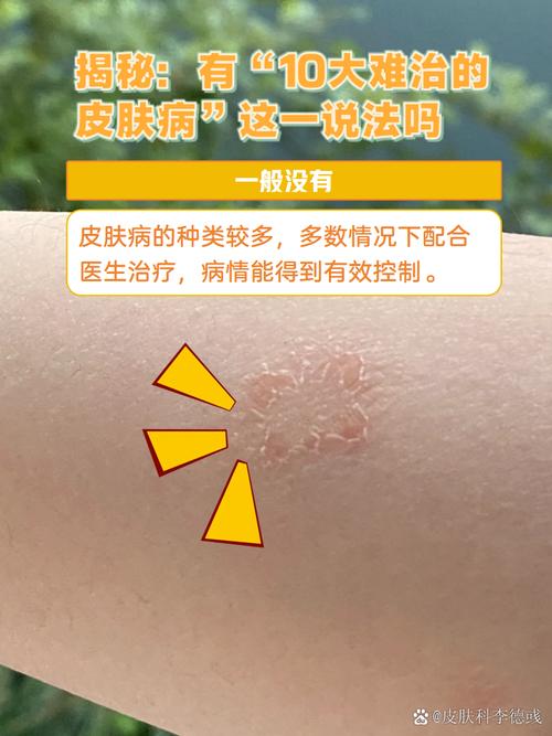 皮肤病为何久治不愈?