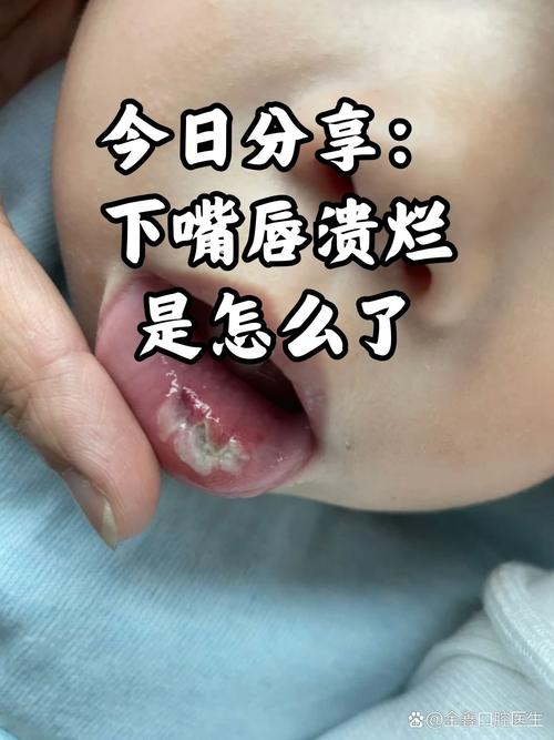 下唇内溃疡反复发作怎么办?