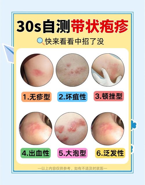 皮肤疱疹的诱因究竟有哪些?