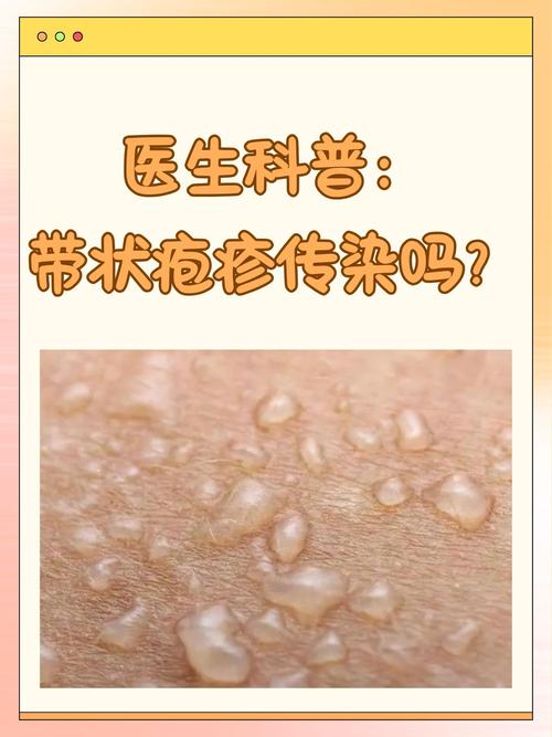 皮肤疱疹的诱因究竟有哪些?