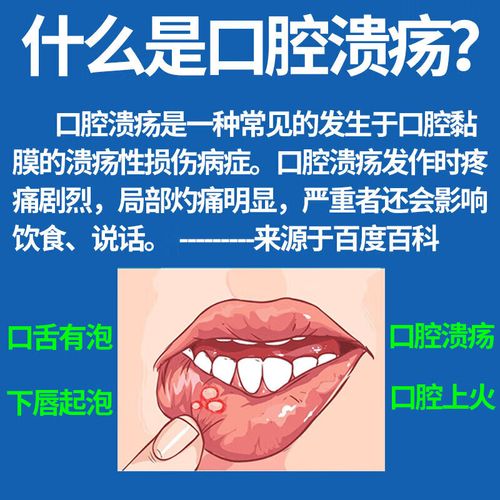 孕妇口腔溃疡安全用药有哪些?