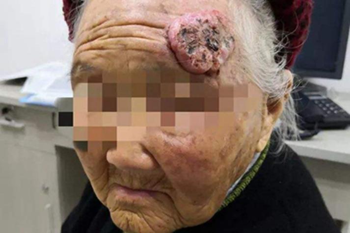 皮肤鳞状上皮乳头状瘤是什么?