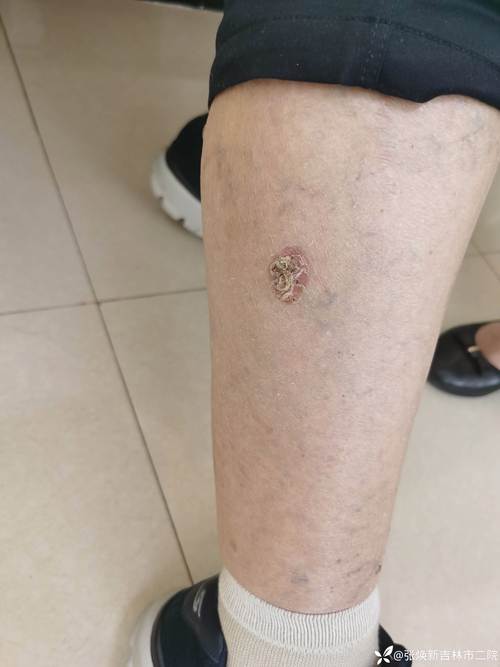 皮肤鳞状上皮乳头状瘤是什么?