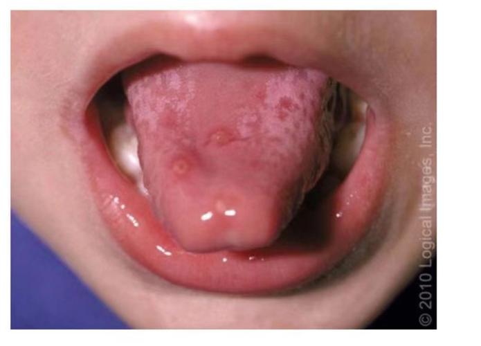 两岁宝宝口腔疱疹图片长这样怎么办?