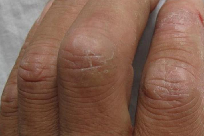 手指关节皮肤硬裂,是缺什么还是生病了?