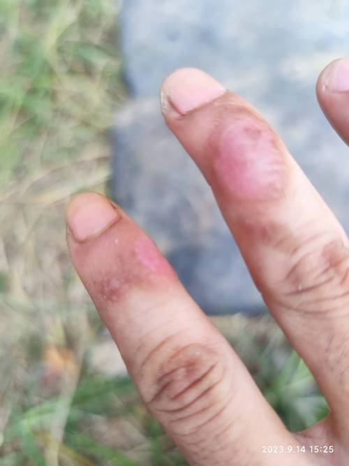 手指关节皮肤硬裂,是缺什么还是生病了?