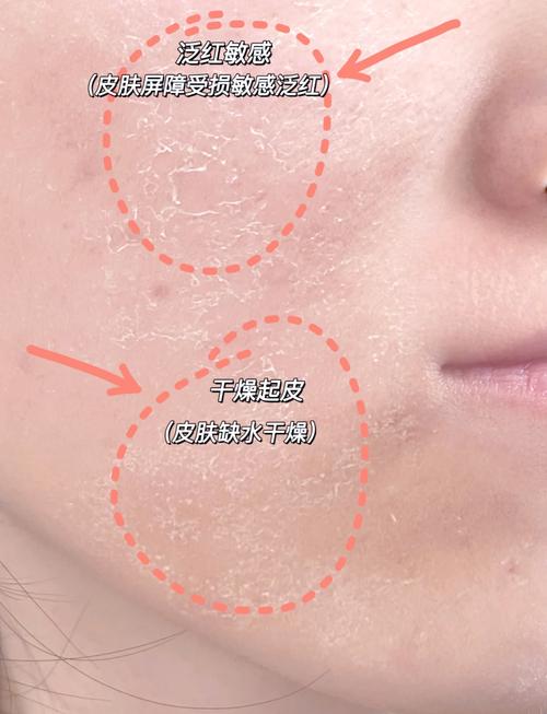 皮肤起皮快速解决,这3招管用吗?