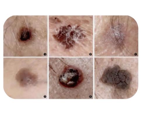 皮肤肿瘤诱因有哪些?