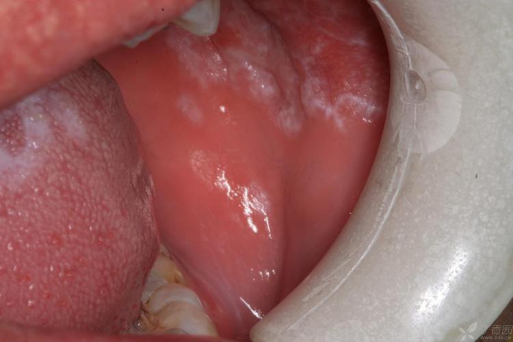 口腔扁平苔藓癌变征兆有哪些?
