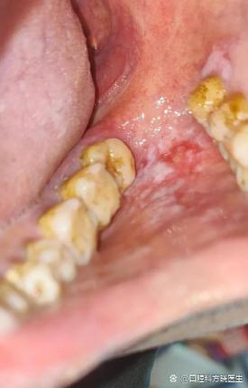 口腔扁平苔藓癌变征兆有哪些?