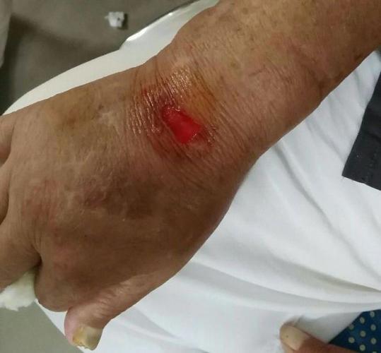 医用粘胶为何会损伤皮肤?